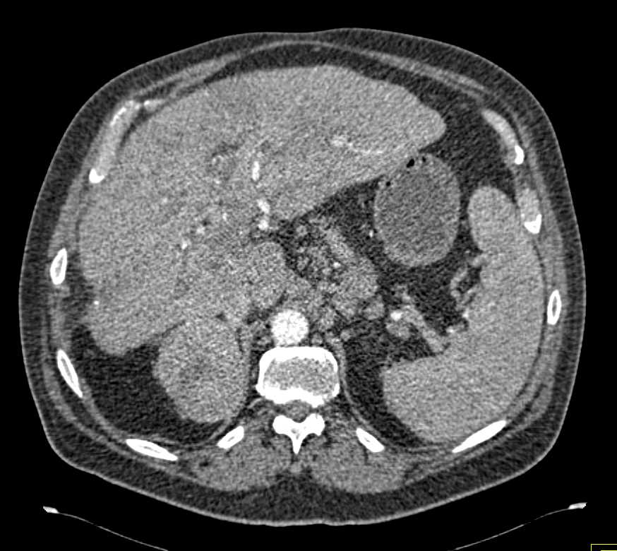 Metastatic Renal Cell Carcinoma to the Liver , Ribs and Adrenal - CTisus CT Scan