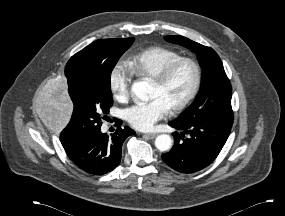 Metastatic Renal Cell Carcinoma to the Liver , Ribs and Adrenal - CTisus CT Scan