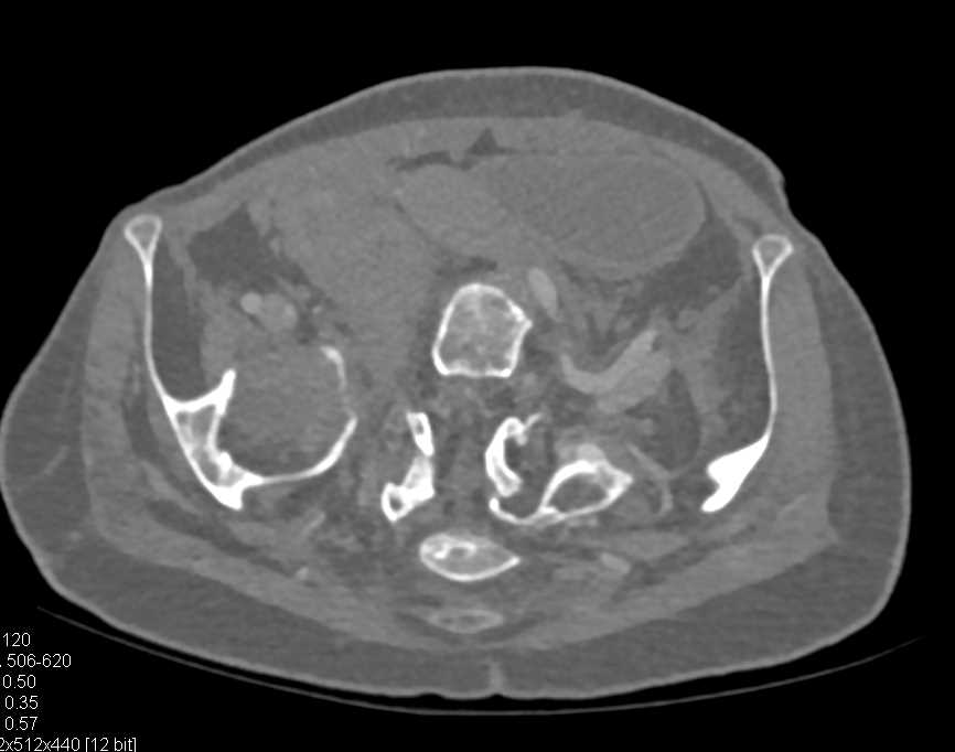 Osteogenesis Imperfecta - CTisus CT Scan