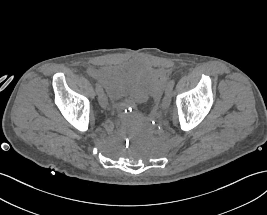 Recurrent Rectal cancer Invades the Sacrum - CTisus CT Scan