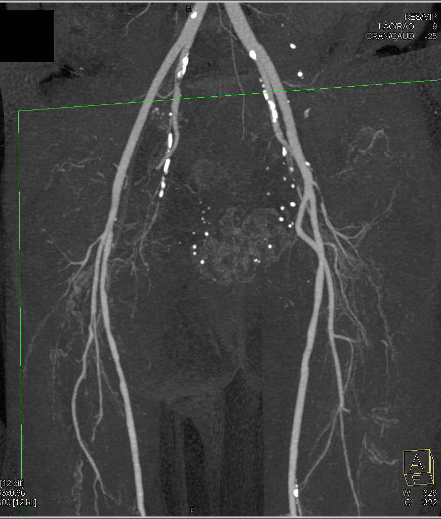 Popliteal Artery Aneurysm on Dual Energy CTA - CTisus CT Scan