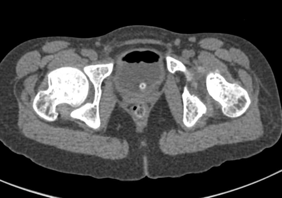 Avascular Necrosis (AVN) in Patient with Hip and Acetabular Deformities - CTisus CT Scan