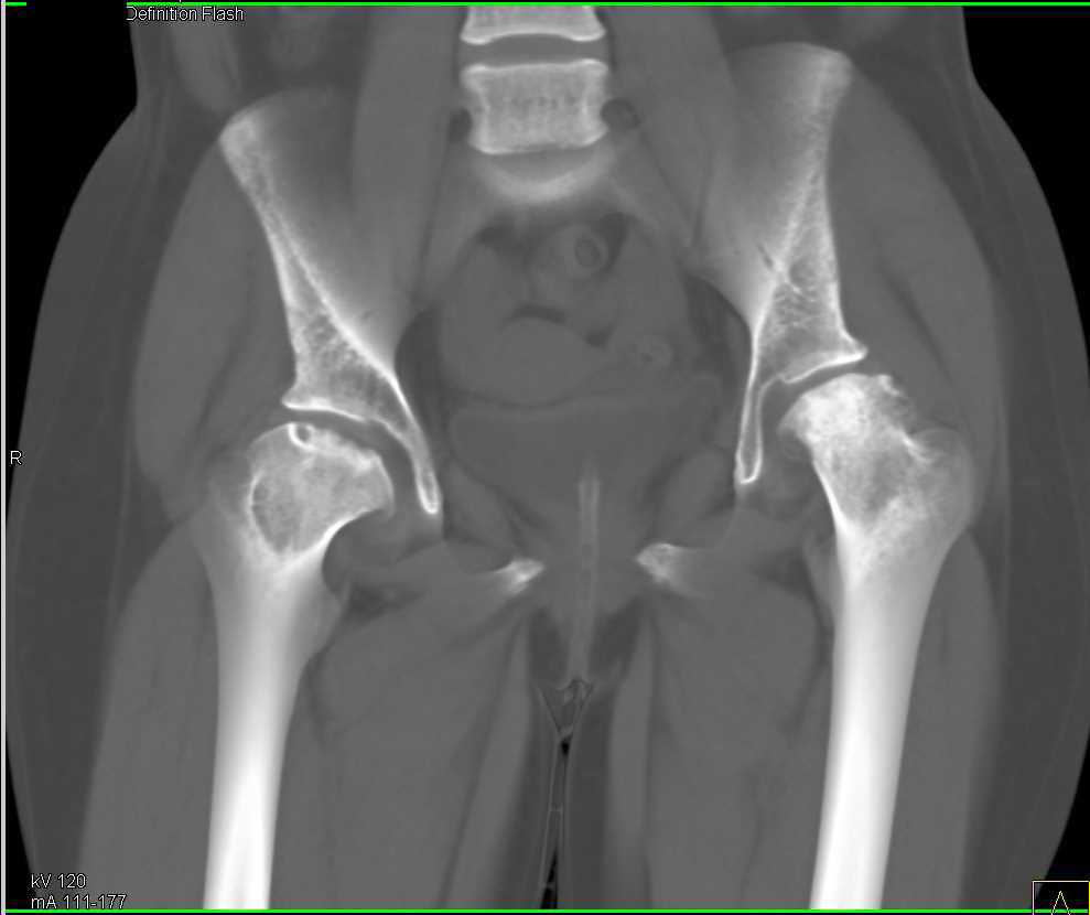 Avascular Necrosis Avn In Patient With Hip And Acetabular Deformities Musculoskeletal Case