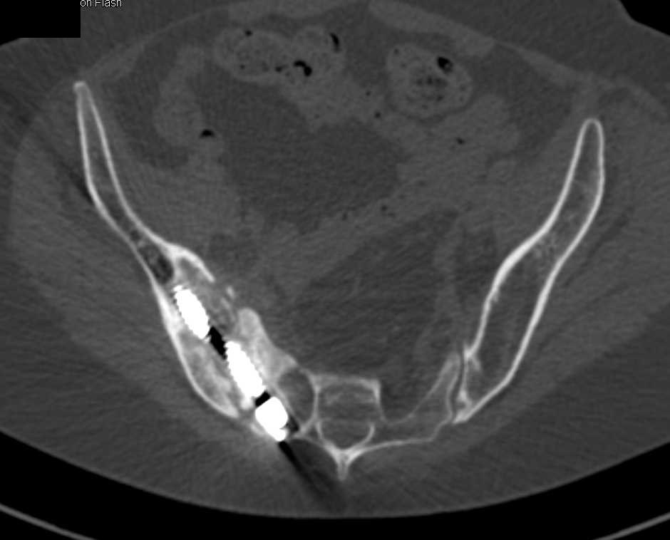 Resorption of Bone Around Pins in Iliac Bone - CTisus CT Scan