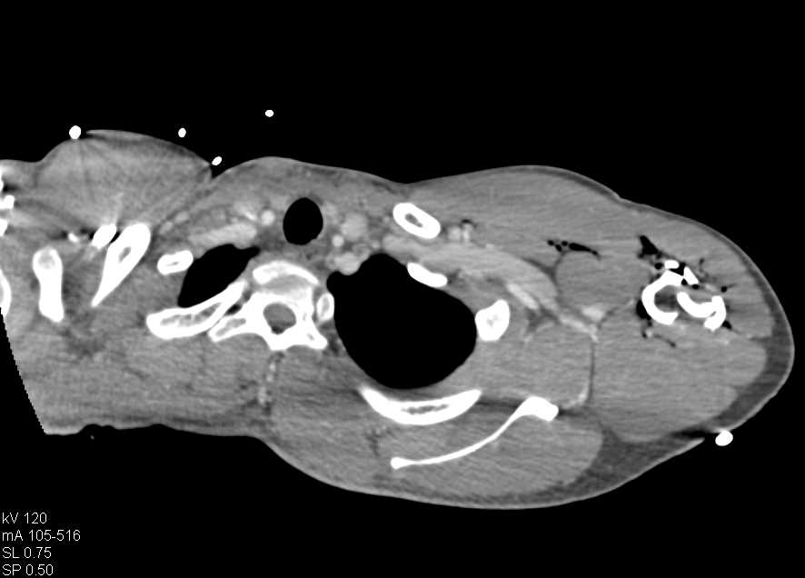 Comminuted Humerus Fracture Without Vascular Injury - CTisus CT Scan