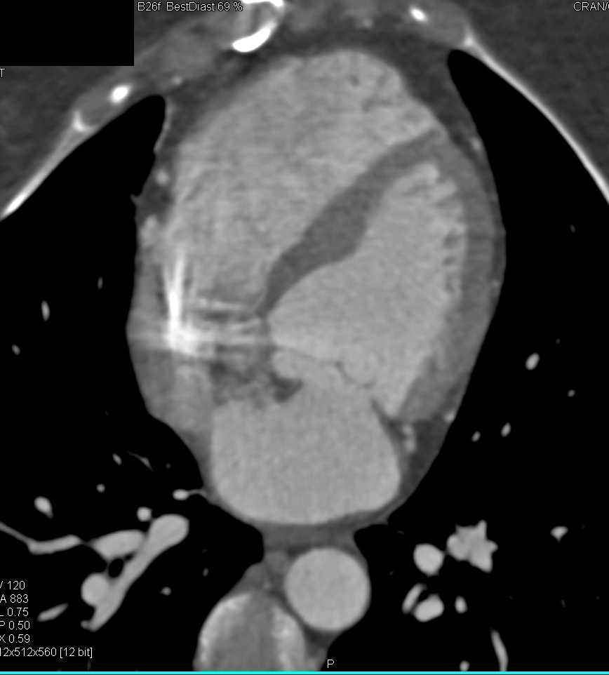 Marfan Syndrome with Large Pelvic Mass due to Dural Ectasia - CTisus CT Scan