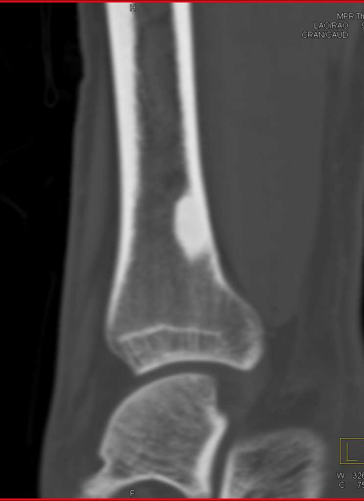 Non-Ossifying Fibroma - CTisus CT Scan