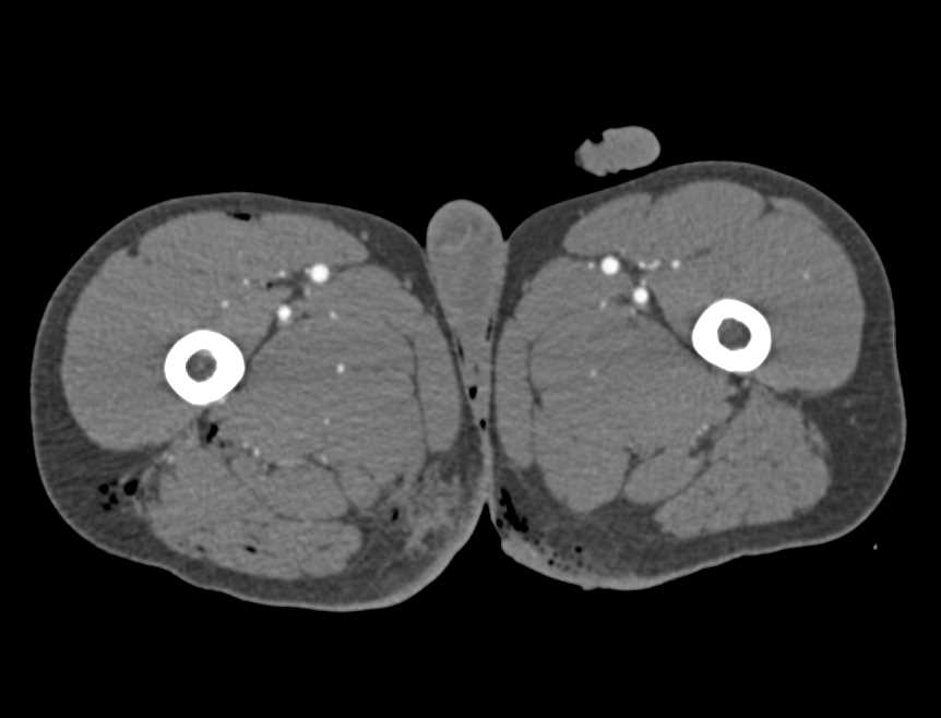 CTA s/p GSW Without Vascular Injury - CTisus CT Scan