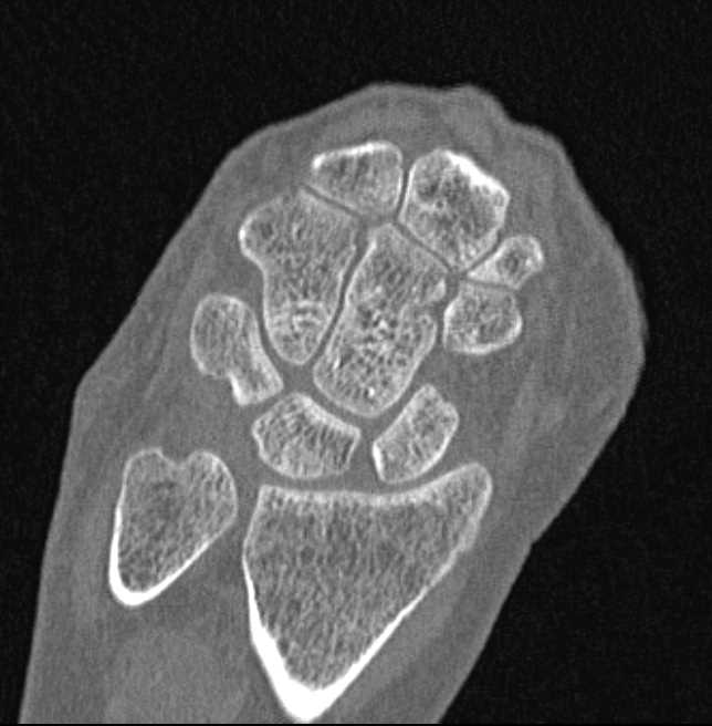 Neurofibroma in the Wrist - CTisus CT Scan