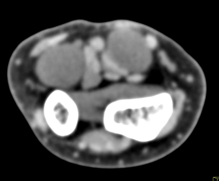 Neurofibromas in the Wrist - CTisus CT Scan