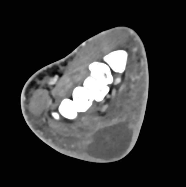 Abscess in Soft Tissues of the Wrist in Intravenous Drug Abuse (IVDA) Patient - CTisus CT Scan