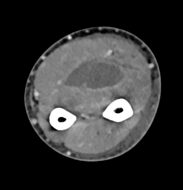 Abscess in Soft Tissues of the Wrist in Intravenous Drug Abuse (IVDA) Patient - CTisus CT Scan