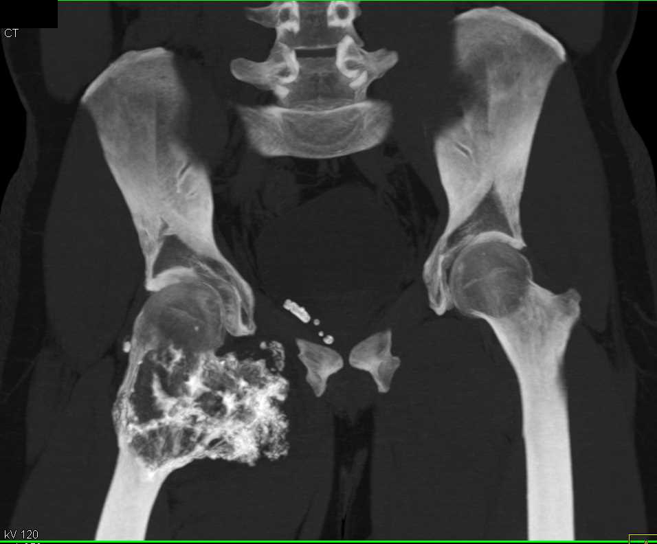 Chondrosarcoma Arises in an Osteochondroma - CTisus CT Scan