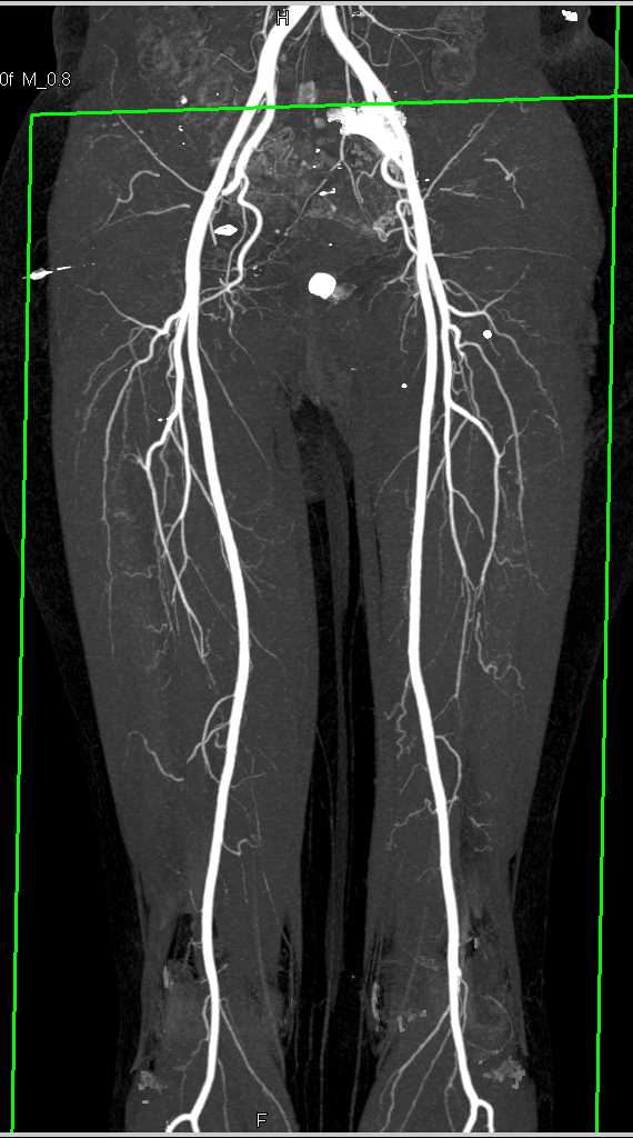 Normal DE CT Runoff - CTisus CT Scan