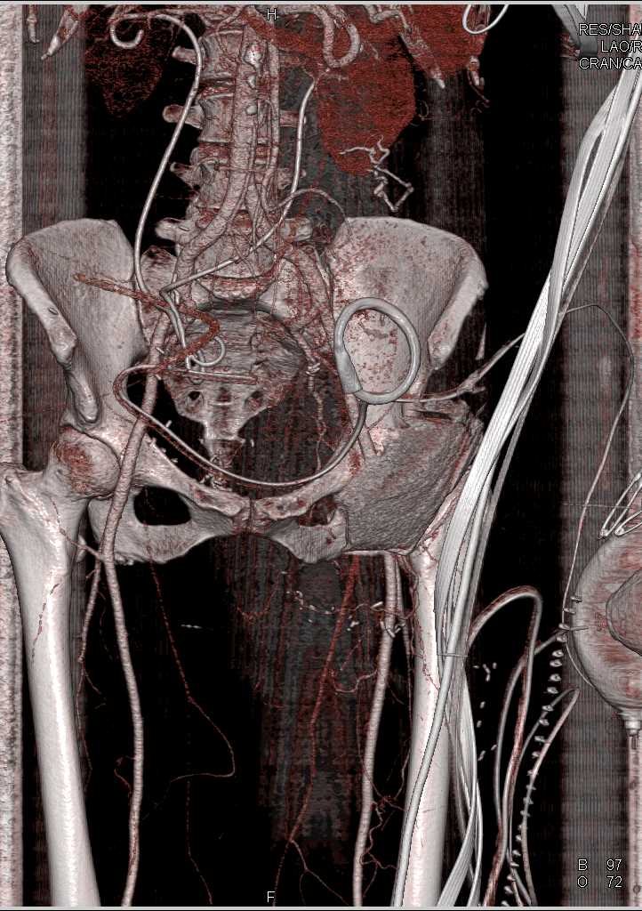 Resection of Thigh Mass with Post Operative Changes - CTisus CT Scan