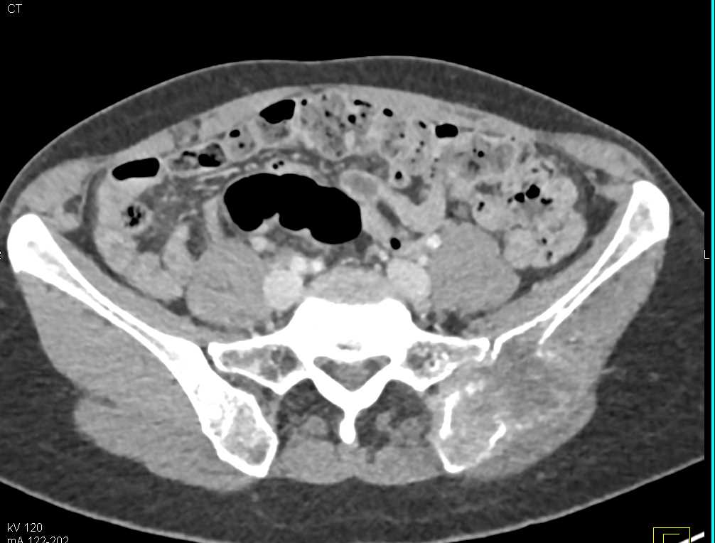 Metastatic Renal Cell Carcinoma to the Iliac Bone - CTisus CT Scan