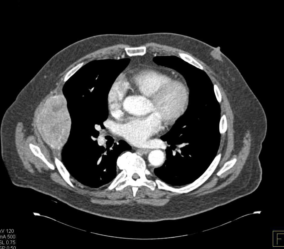 Metastatic Renal Cell Carcinoma with Rib Metastases - CTisus CT Scan