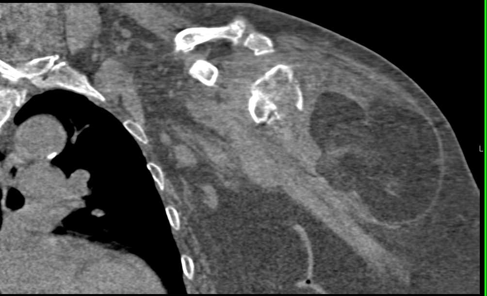 Humerus Fracture - CTisus CT Scan