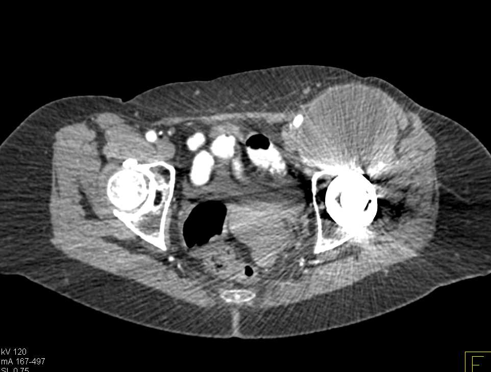 Degenerative Joint Disease (DJD) Left Hip with Large Cyst due to DJD (Large Geode) - CTisus CT Scan