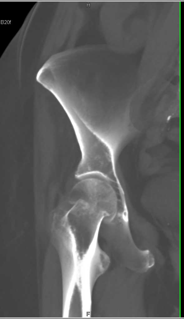 Impacted Femur Fracture - CTisus CT Scan