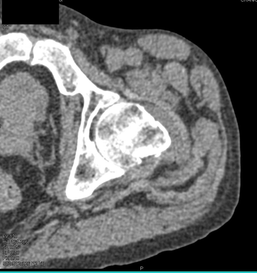 Subtle Left Femur Fracture - CTisus CT Scan