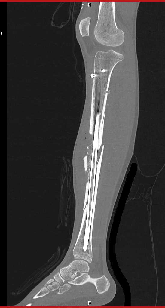Open Reduction Internal Fixation (ORIF) of Tibia and Fibular Fractures with Drain in Place and Soft Tissue Injury - CTisus CT Scan