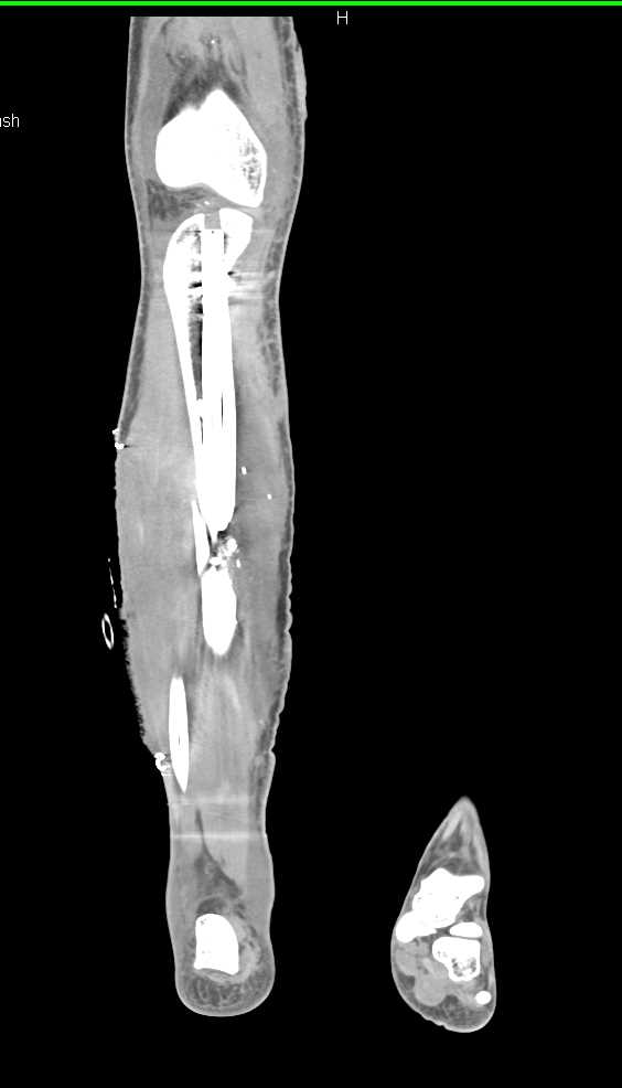 Open Reduction Internal Fixation (ORIF) of Tibia and Fibular Fractures with Drain in Place and Soft Tissue Injury - CTisus CT Scan