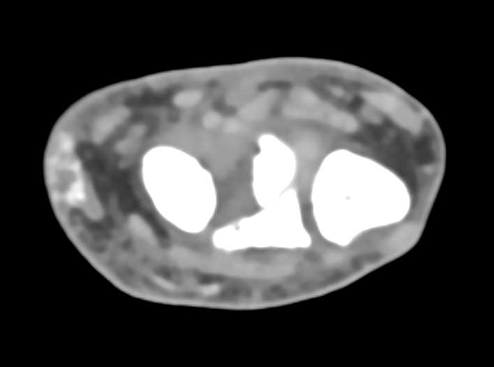 Soft Tissue Calcification Possibly due to Old Trauma - CTisus CT Scan