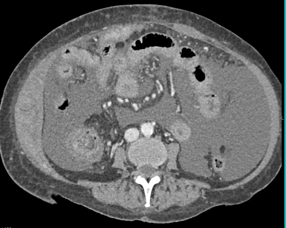 Multiple Addominal Wall Hematomas - CTisus CT Scan