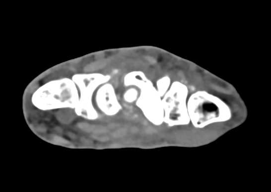 Degenerative Changes due to Repeated Trauma in Carpal Bones and Joint Space - CTisus CT Scan