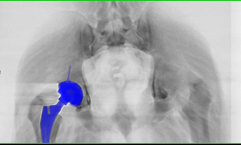 3d Of A Right Total Hip Replacement Musculoskeletal Case Studies