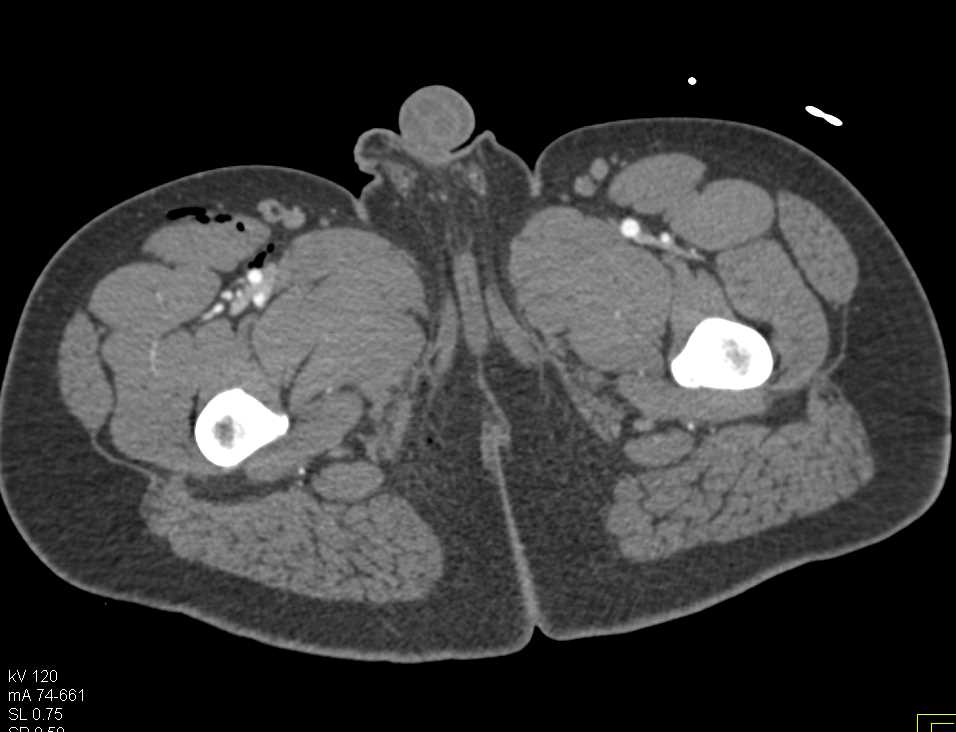 GSW Right Thigh with Normal CTA - CTisus CT Scan