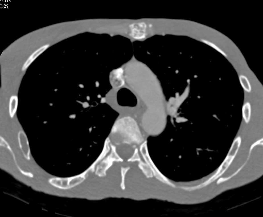 Bony Remodeling due to End Stage Renal Disease - CTisus CT Scan