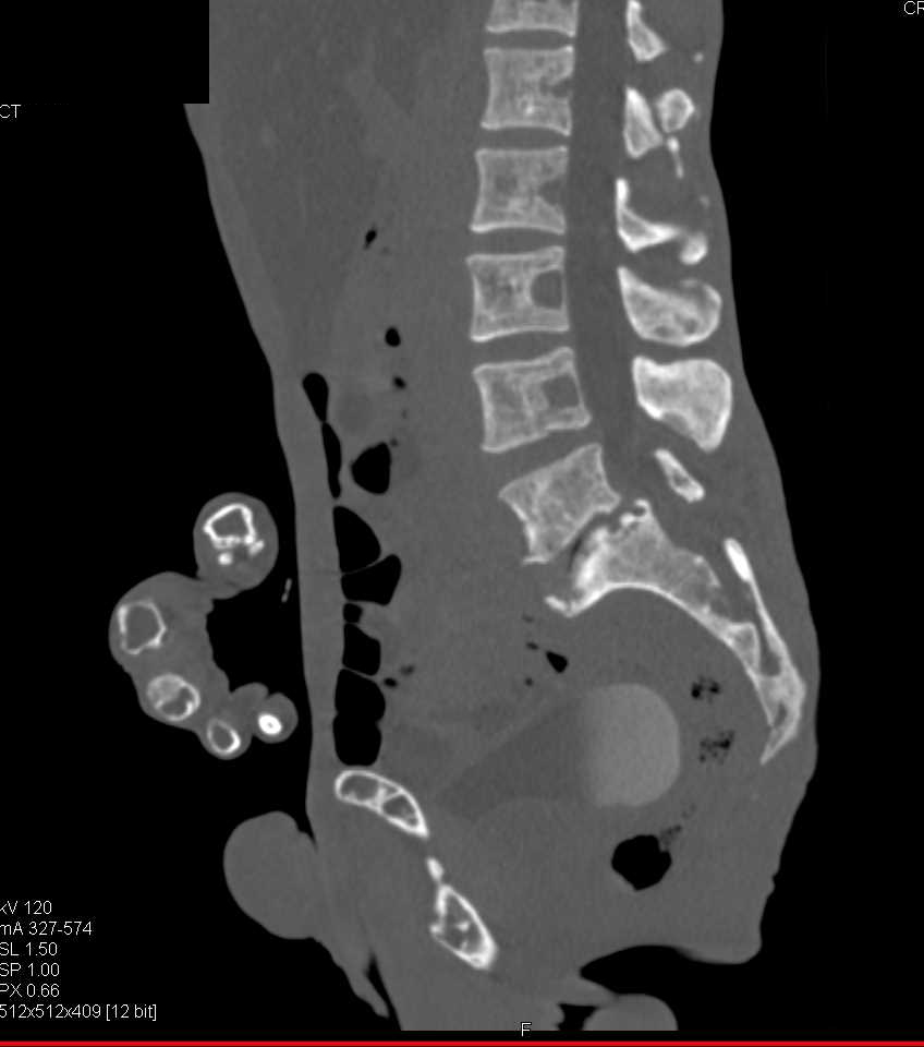 Bony Remodeling due to End Stage Renal Disease - CTisus CT Scan