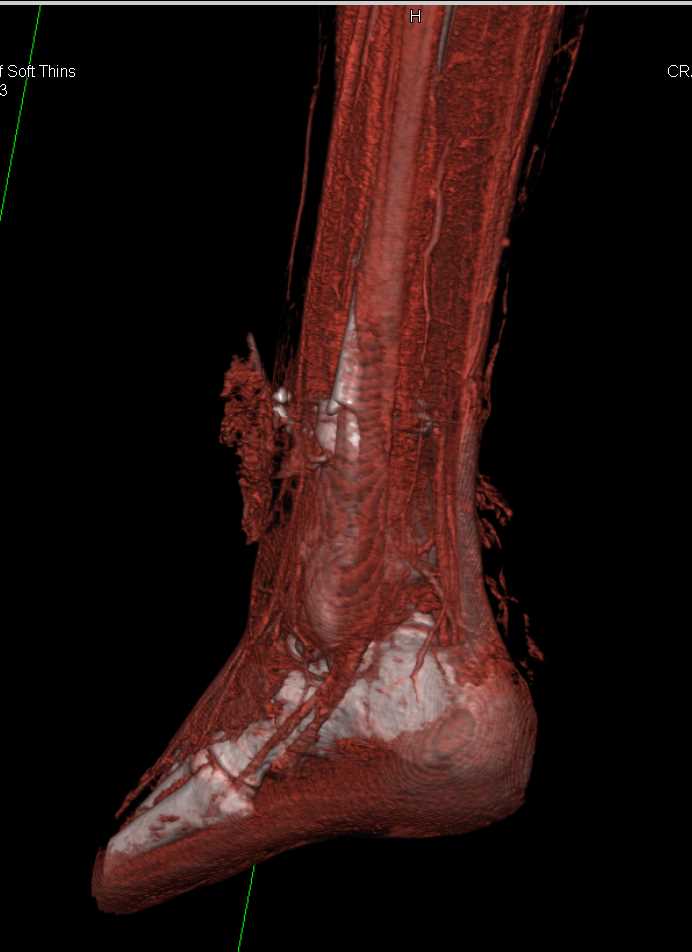 GSW With Comminuted Tibia/Fibula Fractures with Soft Tissue and Vascular Injury - CTisus CT Scan