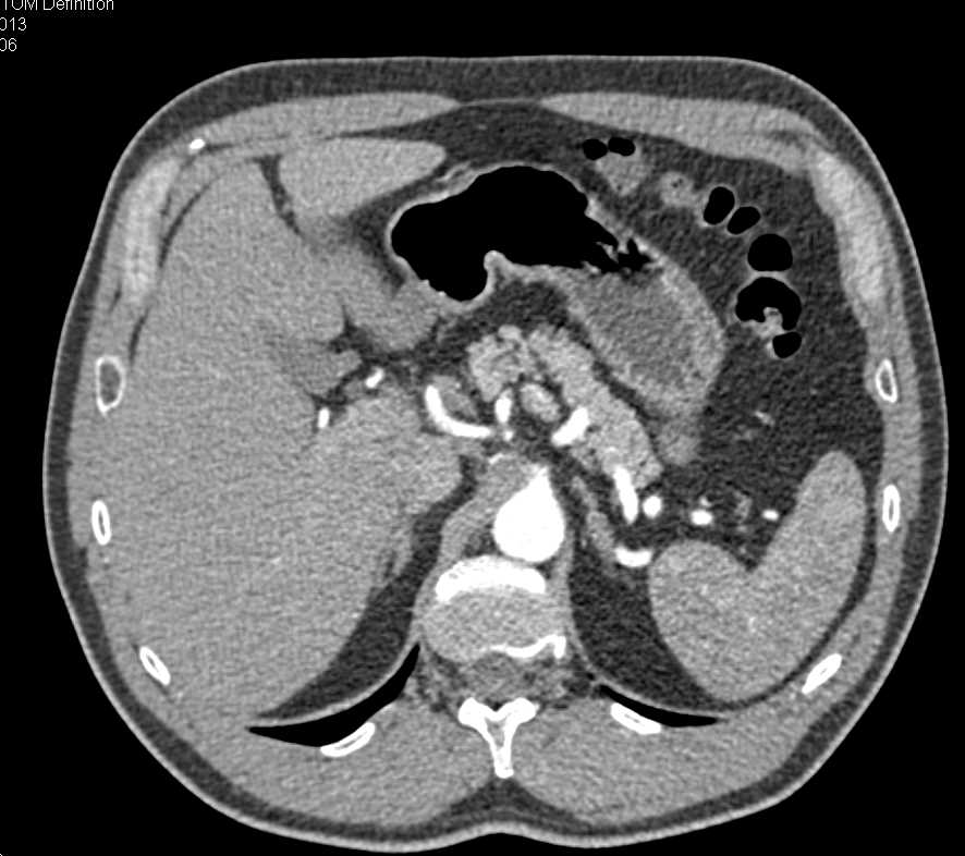 Sarcoma in the Left Psoas Muscle - CTisus CT Scan