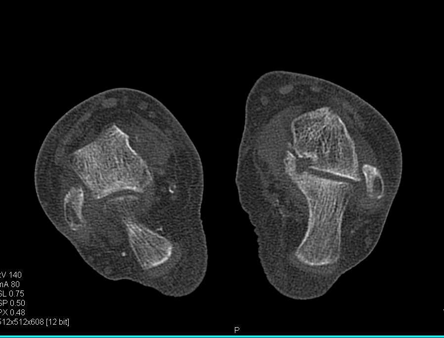 Fibrous Tarsal Coalition on the Left Foot - CTisus CT Scan