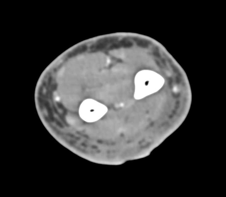 Dog Bite with Ulceration of the Skin and Inflammation - CTisus CT Scan