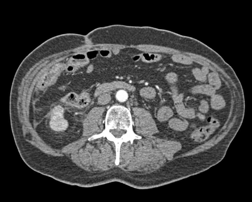 Metastatic Renal Cell Carcinoma to Muscle in Left Iliopsoas Muscle - CTisus CT Scan