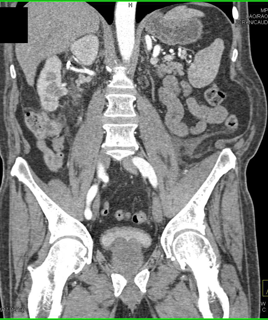 Metastatic Renal Cell Carcinoma to Muscle in Left Iliopsoas Muscle - CTisus CT Scan