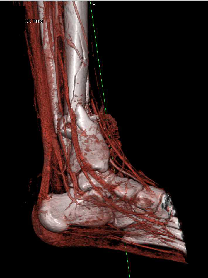 GSW Lower Leg with Bone and Muscle Injury - CTisus CT Scan