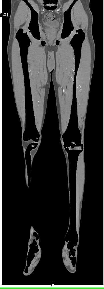 CTA DE Runoff with Occlusion of the Superficial Femoral Artery (SFA)'s Bilaterally - CTisus CT Scan