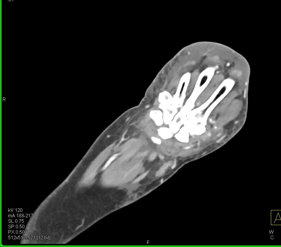 Cellulitis in the Hand - CTisus CT Scan