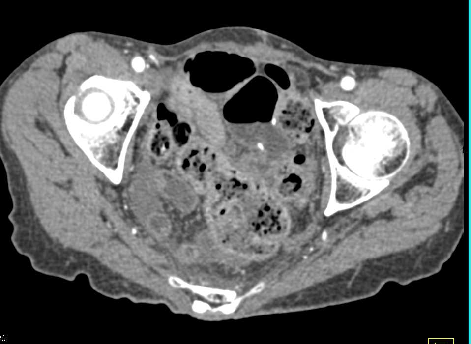 Stress Fracture Sacrum and Rectal Prolapse - CTisus CT Scan