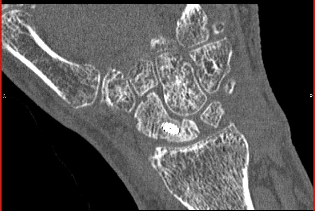 Pin in Scaphoid with Non Union - CTisus CT Scan