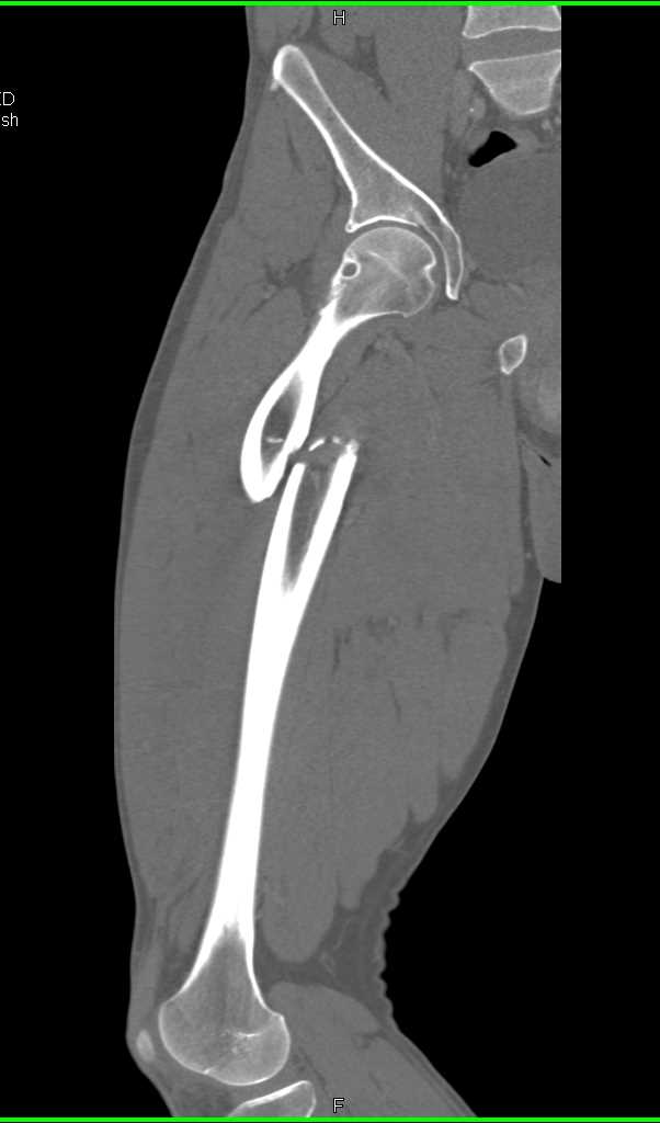 Spiral Femur Fracture - CTisus CT Scan