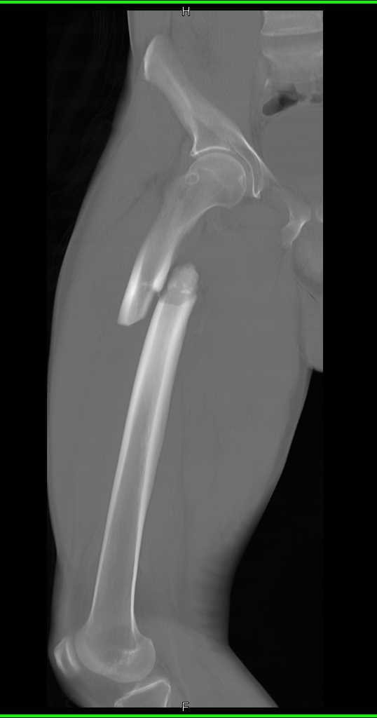 quarterback spiral fracture