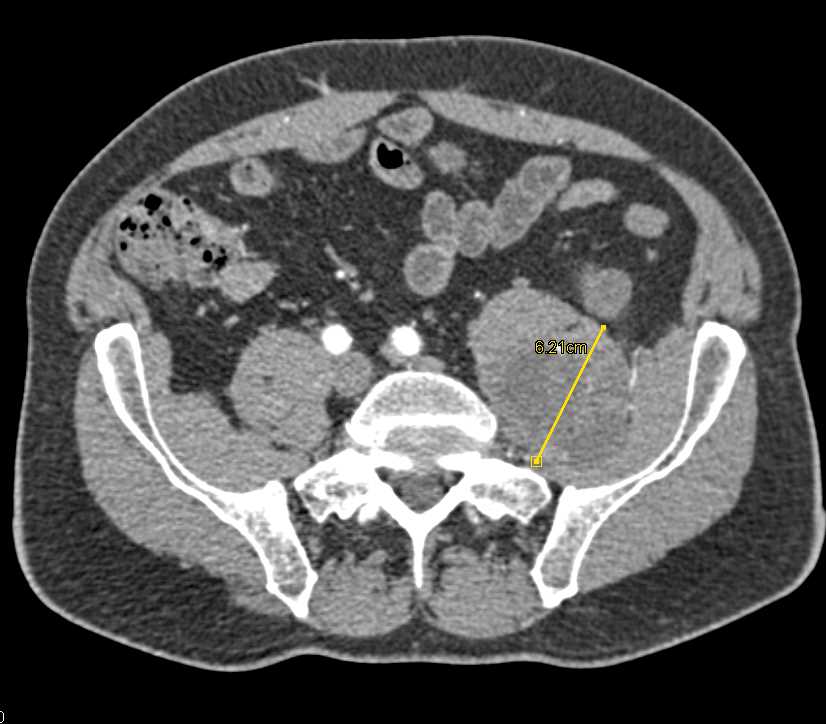 in the Left Iliopsoas Muscle Musculoskeletal Case Studies