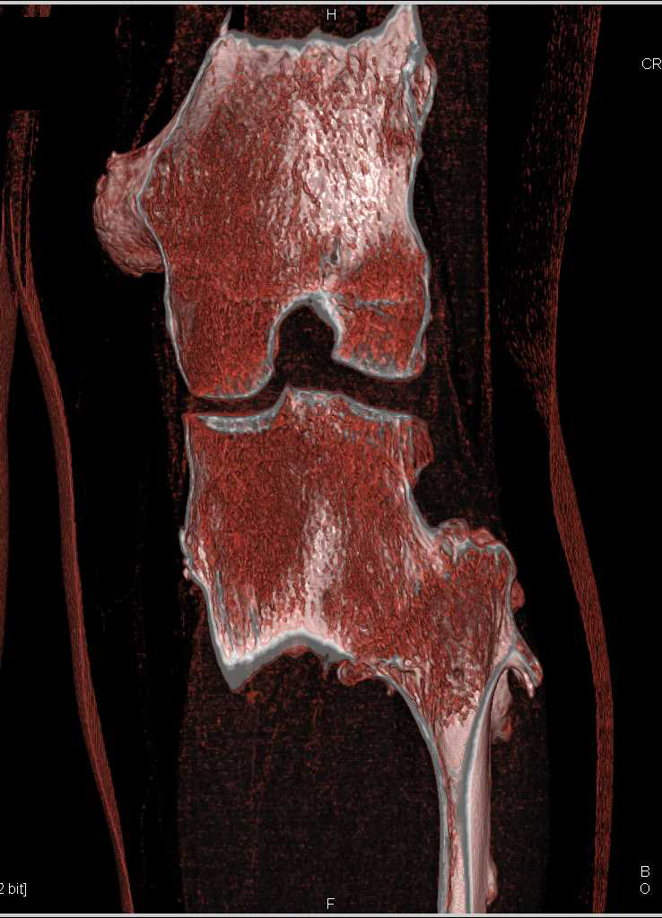 Hereditary Multiple Exostoses - CTisus CT Scan