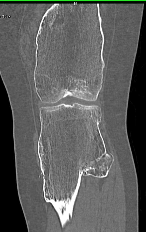 Hereditary Multiple Exostoses - CTisus CT Scan